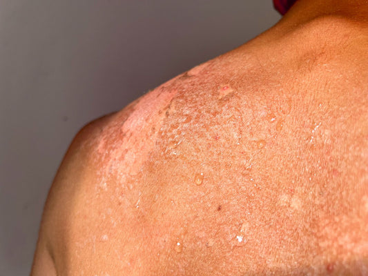 Collagen for Eczema-Prone Skin: What the Research Says