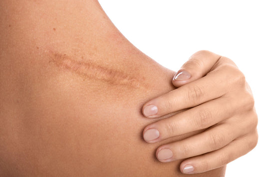 Collagen Supplements for Scars: Do They Really Help Healing?